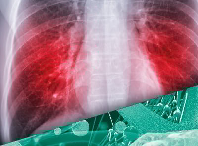 2. Tuberculosis-Imagen_XXV-JC