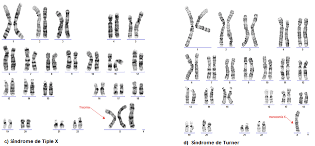 Figura 1. Cariotipos positivos para diferentes anomalías cromosómicas numéricas