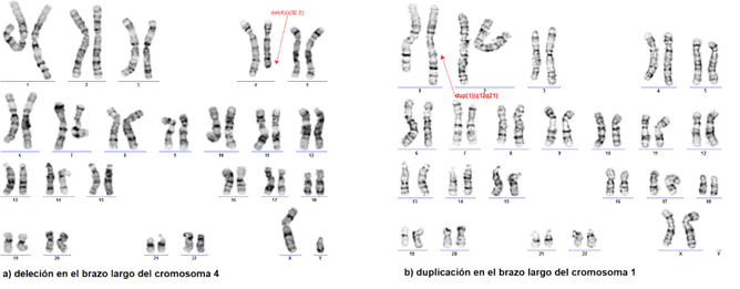 Figura 2. Cariotipos positivos para diferentes anomalías cromosómicas estructurales