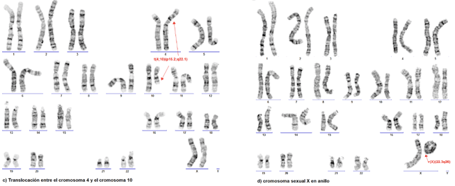 Figura 2. Cariotipos positivos para diferentes anomalías cromosómicas estructurales